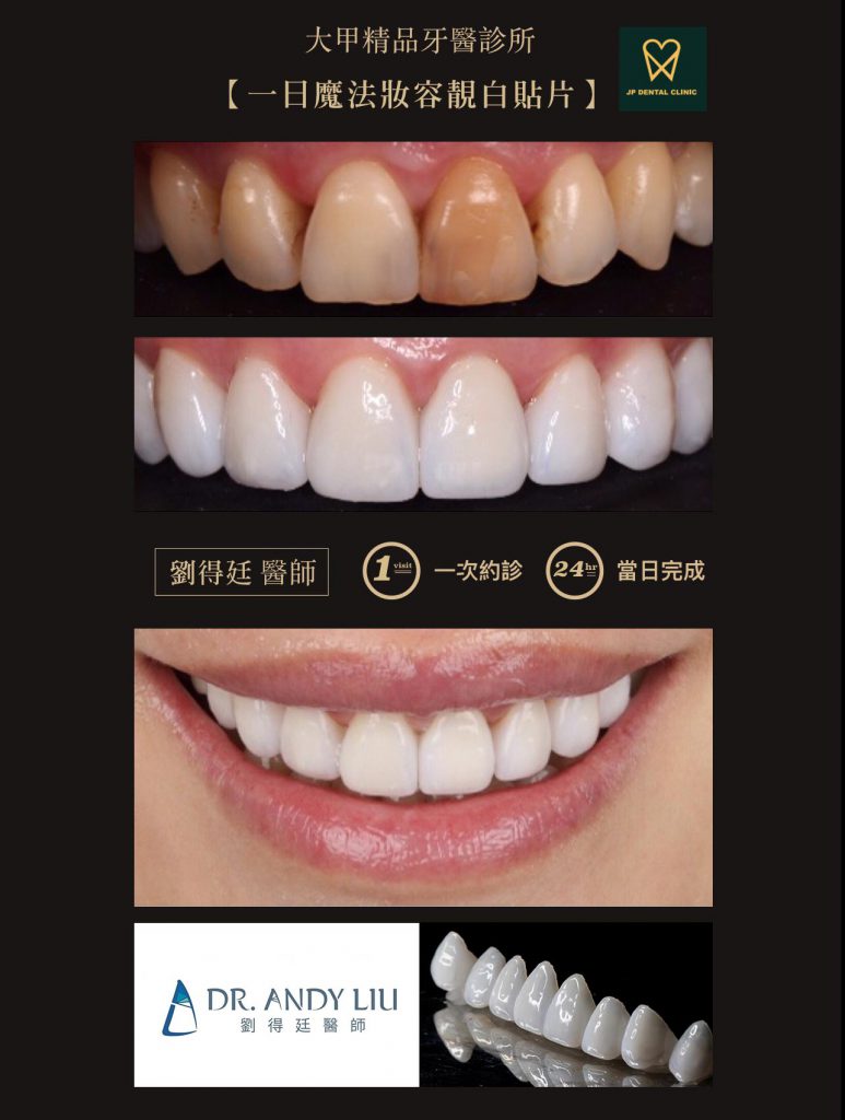 精品牙醫-數位美齒中心-劉得庭醫師-一日矯正美白貼片-陶瓷貼片案例