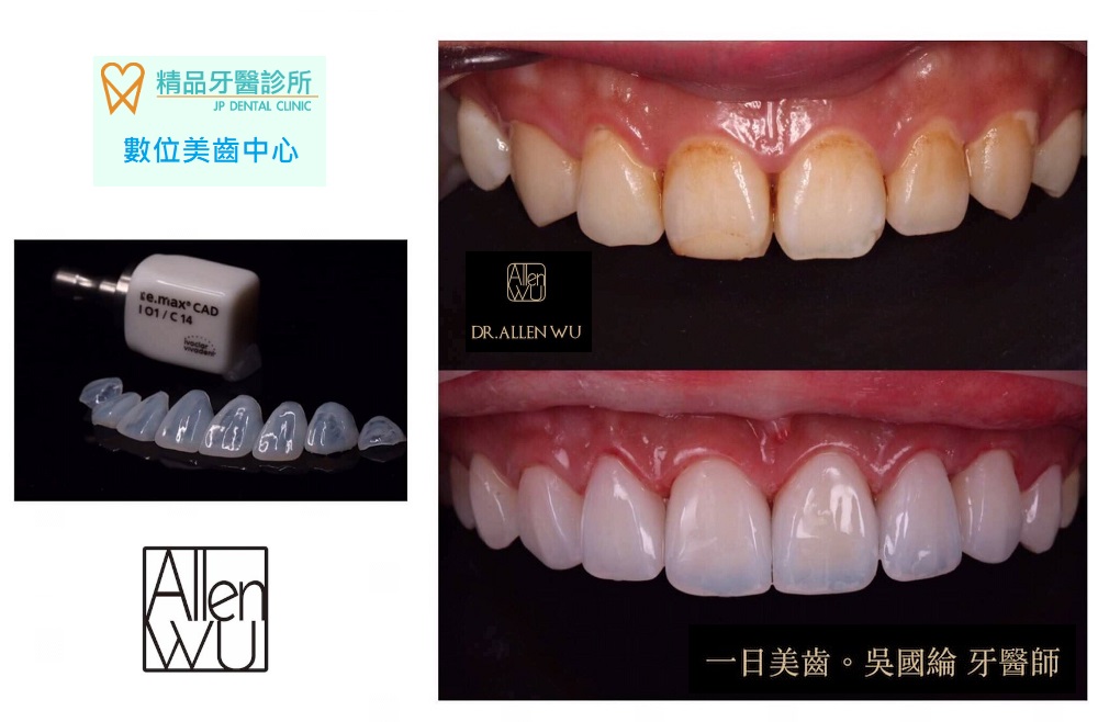 精品牙醫 牙齒美白貼片 大甲美容牙科推薦 吳國綸醫師