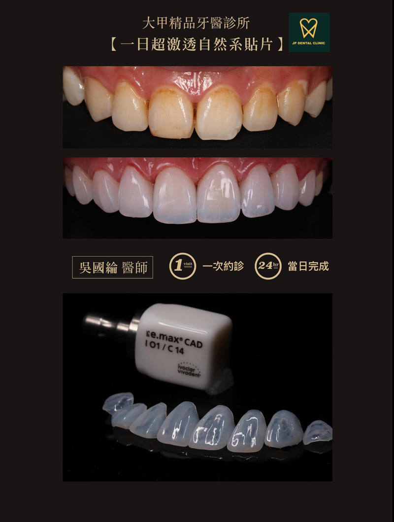 精品牙醫-數位美齒中心-吳國綸醫師-一日超激透自然系貼片