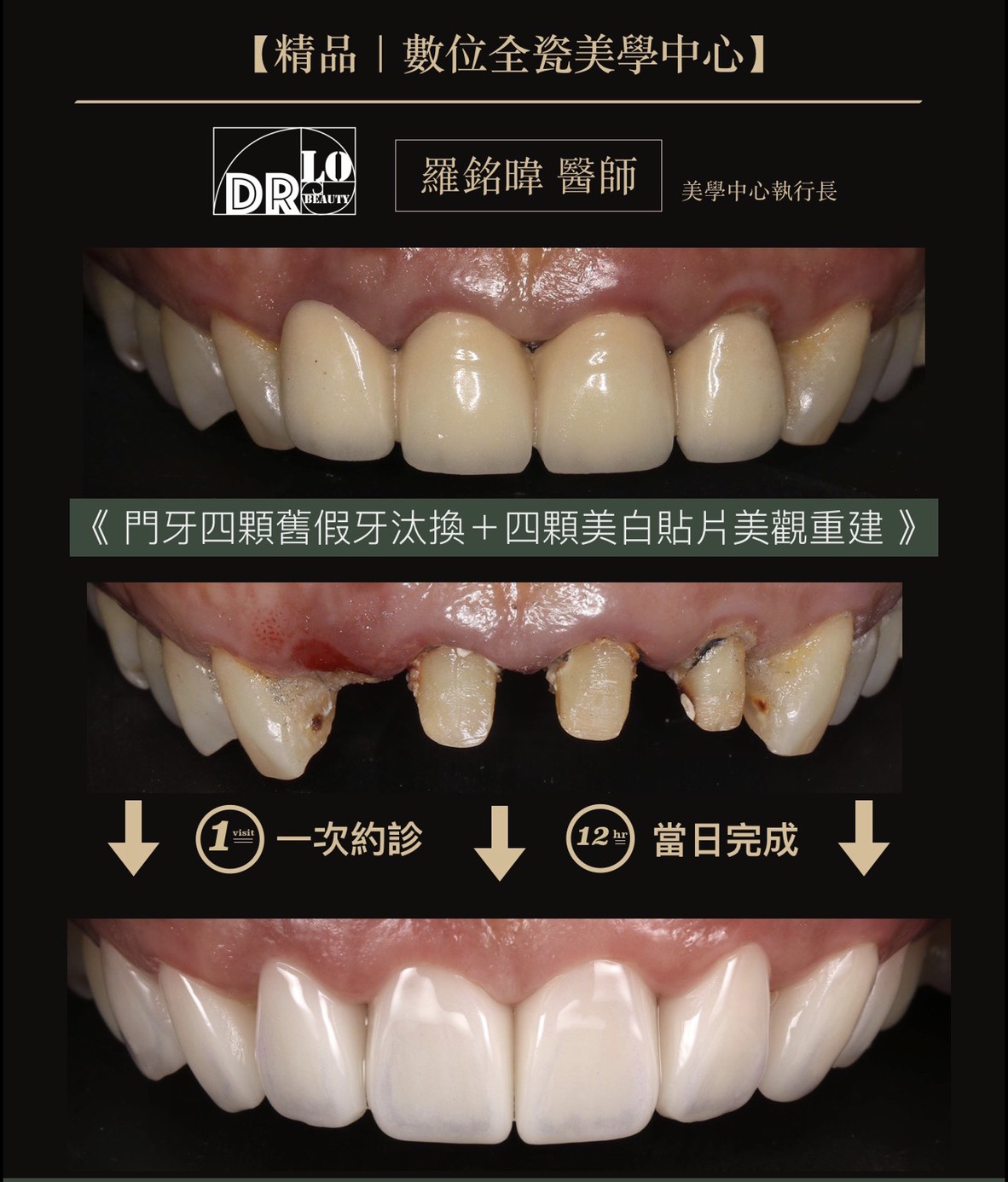 精品牙醫 數位全瓷美學中心 羅銘暐醫師 牙齒美白貼片 一日假牙全瓷冠